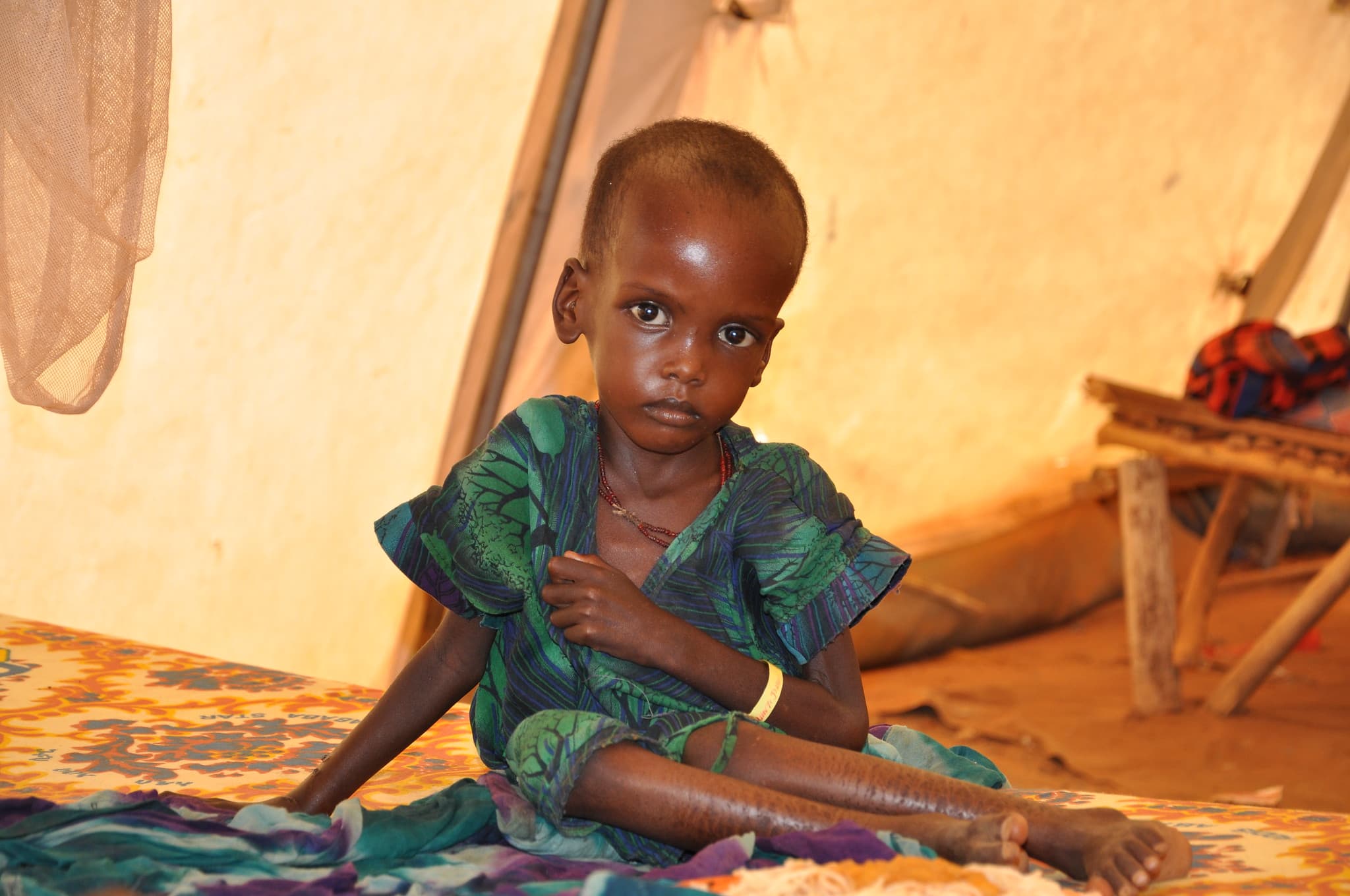 Child Malnutrition Rises Sharply in Yemen as Fighting Escalates