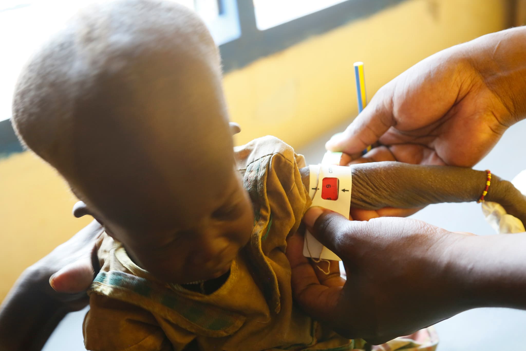 Somalia Child Malnutrition Surges as Aid Cuts Force Facility Closures